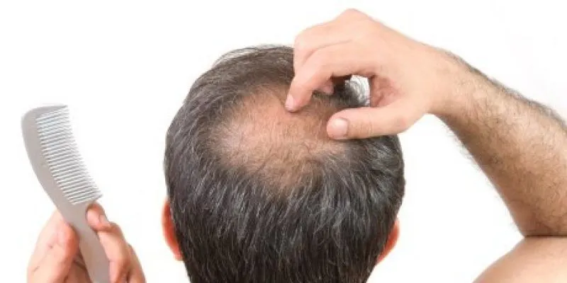 Ilustrasi rambut botak