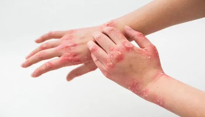 Virus Mpox atau Cacar Monyet di Indonesia