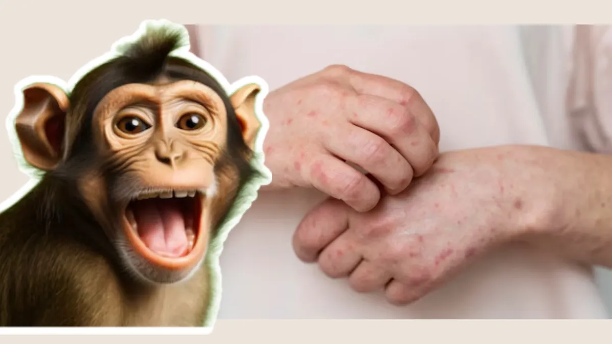 Ilustrasi Virus Mpox atau Cacar Monyet