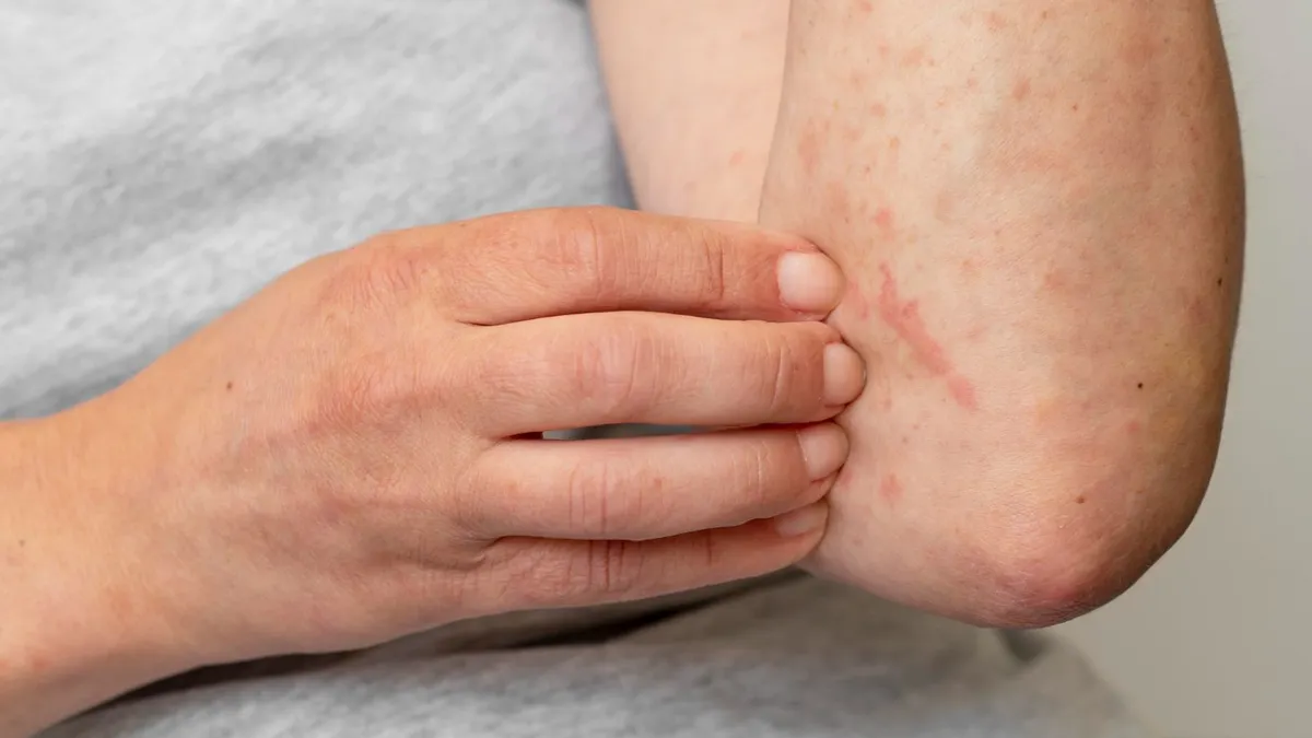 Beberapa kasus Mpox atau cacar monyet terkonfirmasi di enam provinsi dengan total penderita mencapai 88 orang.