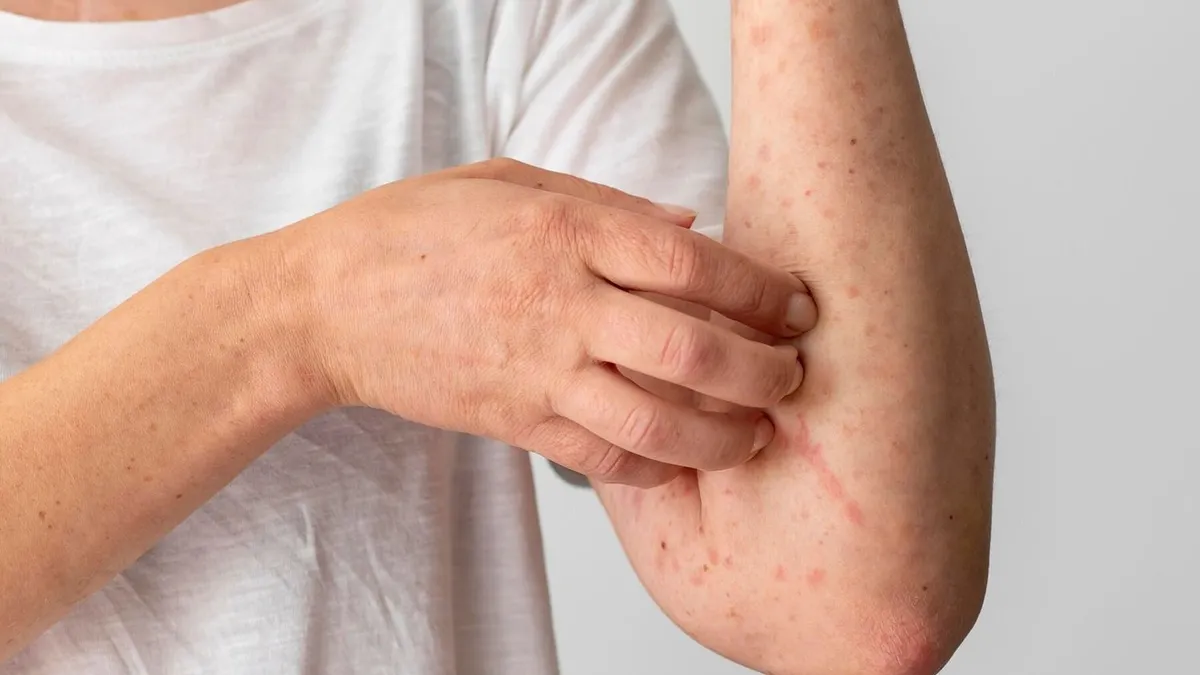 Ilustrasi Mpox atau Monkey Pox atau Cacar Monyet