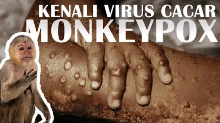 Ilustrasi Mpox atau Monkey Pox atau Cacar Monyet