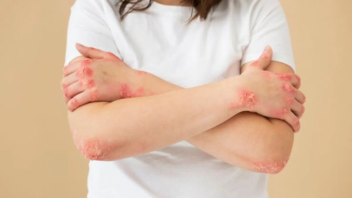 Ilustrasi virus monkeypox atau cacar monyet.