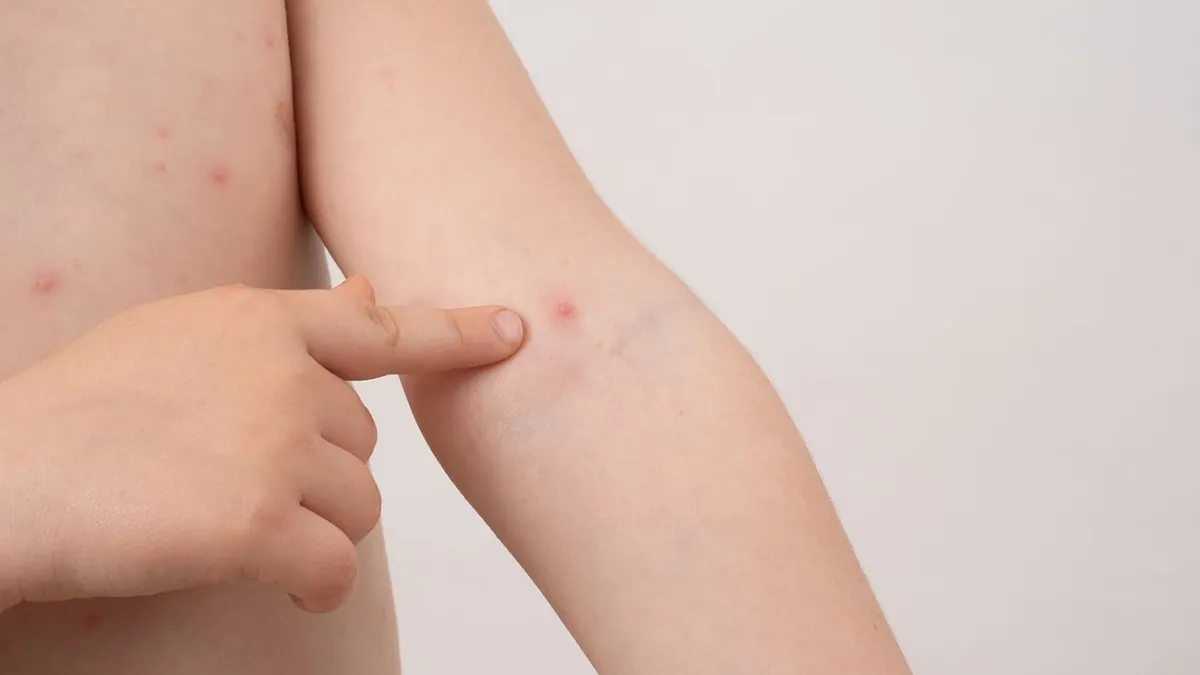 Ilustrasi Virus Mpox
