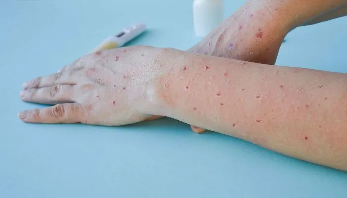 Ilustrasi. Virus Mpox