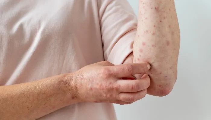 Ilustrasi Mpox atau Monkeypox atau Cacar Monyet