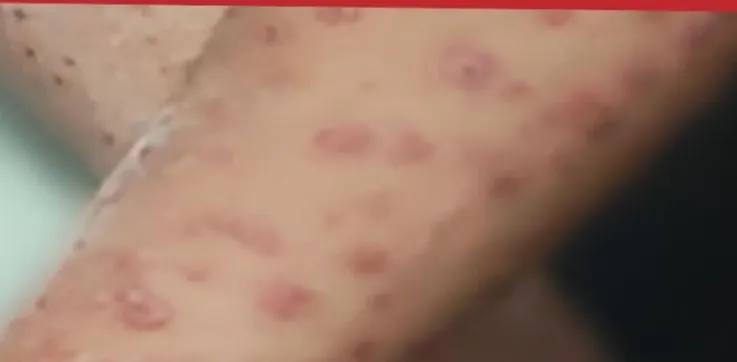 Virus Mpox atau cacar monyet viral kembali setelah WHO mengatakan virus ini termasuk kedaruratan kesehatan masyarakat global.
