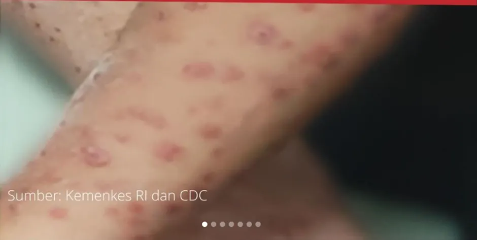 Baru-baru ini pada bulan Agustus 2024, ditemukan seorang dengan suspek MPOX atau Cacar Monyet berdasarkan laporan Kementerian Kesehatan.