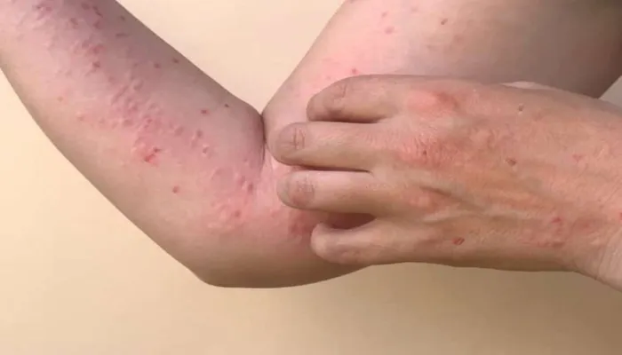 Cacar Monyet atau Monkey Pox
