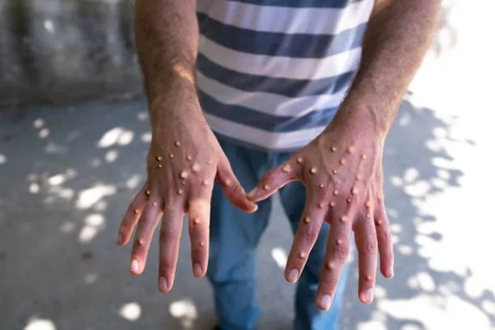 Untuk mengurangi dampak penyebaran virus Mpox ini adalah dengan mengetahui bagaimana cara penularan virus Mpox dari manusia ke manusia.