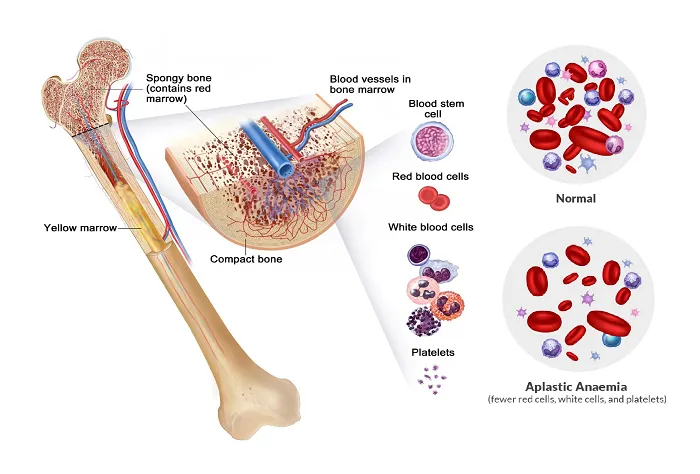 Ilustrasi penyakit Anemia Aplastik