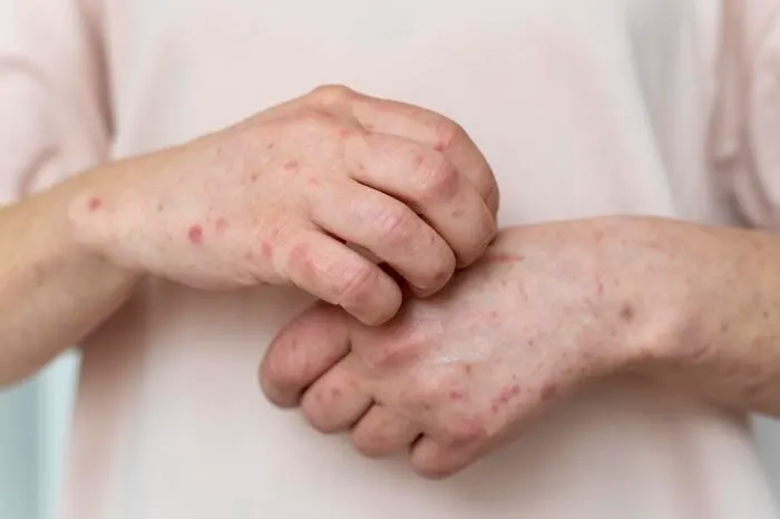 Baru-baru ini Indonesia telah tengah dihebohkan dengan adanya kasus Mpox alias penyakit cacar monyet.