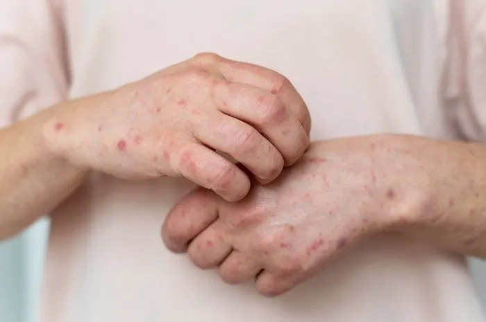 Ilustrasi. Kasus Monkeypox Alias Cacar Monyet di Indonesia Alami Kenaikan, Kenali Gejala Awal dan Lakukan Pencegahan!