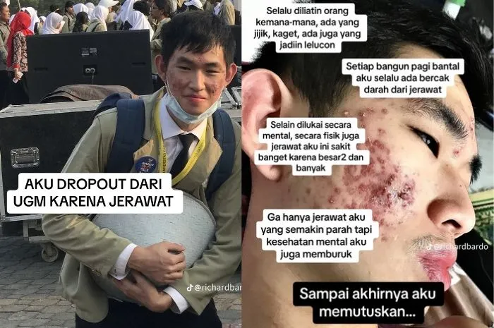 Viral Kisah Mahasiswa UGM Drop Out Gegara Jerawat, Endingnya Bikin Warganet Takjub