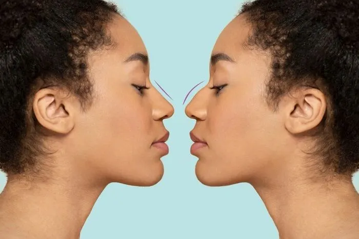 Ilustrasi Kepribadian Seseorang Berdasarkan Bentuk Hidung yang Dimiliki.