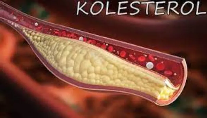 Kamu Wajib Tahu, Begini Ciri-ciri Gejala Kolesterol Tinggi Pada Tubuh, Ternyata Bisa Dilihat dari Kaki!