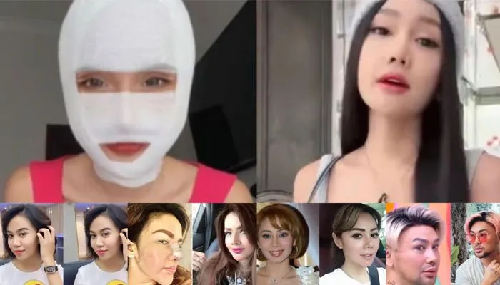 Kaleidoskop 2022: 5 Deretan Artis yang Lakukan Operasi Plastik Sepanjang 2022, Ada yang Sampai Ganti Kepala