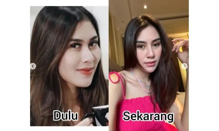 Syahnaz Sadiqah, adik dari Raffi Ahmad menjadi sorotan netizen. Dirinya dinilai melakukan operasi plastik karena berbeda dengan kondisi wajah sebelumnya.