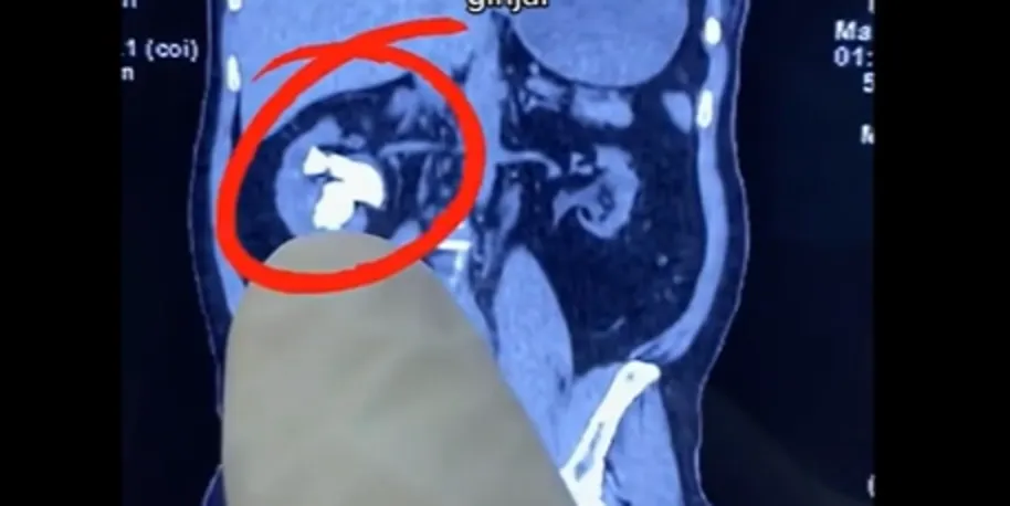 Viral sebuah video seorang pasien wanita yang punya keluhan nyeri pinggang namun ternyata batu ginjal.