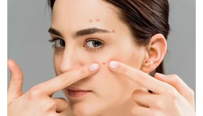 Tips hilangkan bekas jerawat dan flek hitam