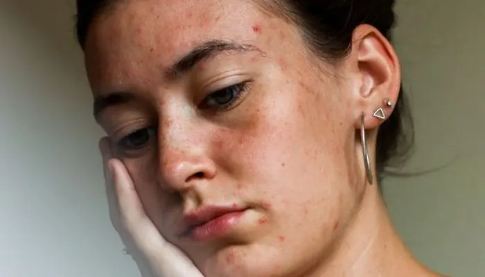 Tips menjaga dan Memperbaiki Skin Barrier Agar Kondisi Kulit Tidak ‘Rewel’