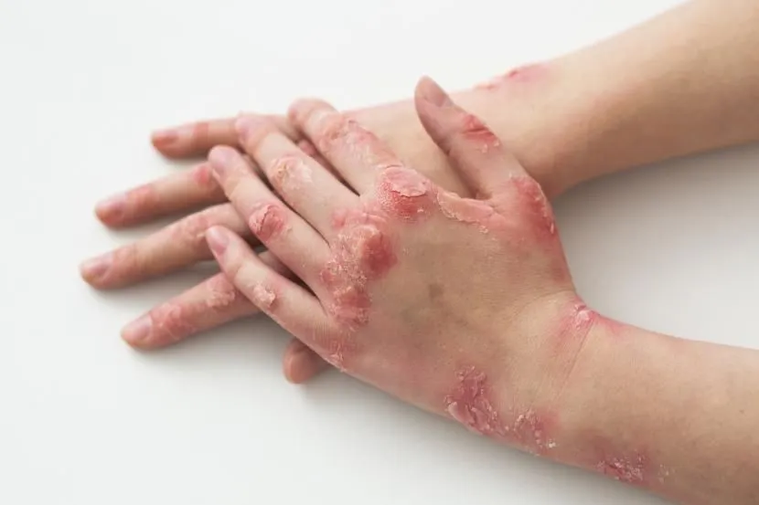 Pasien pertama positif Monkeypox atau cacar monyet di Indonesia dinyatakan sembuh