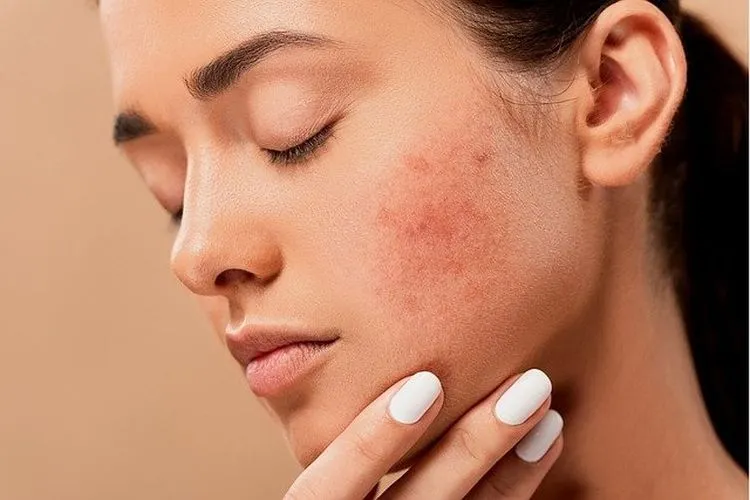 Tips Memilih Skincare untuk ‘Membersihkan’ Jerawat dari Wajah Kamu (ilustrasi)/pixabay