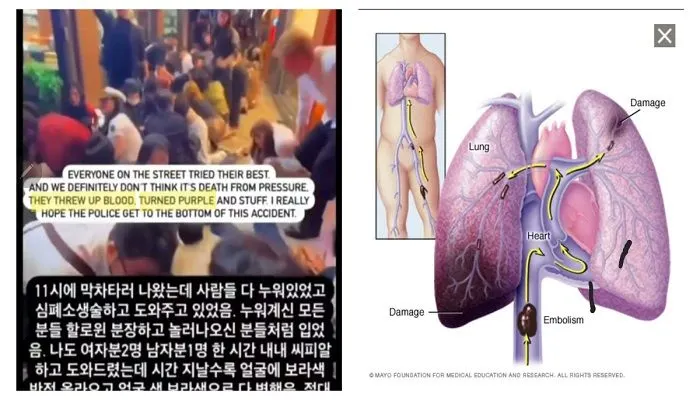 beredar postingan korban pada tragedi Itaewon mengalami muntah dara menjadi 'ungu'.