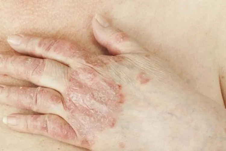 ilustrasi gangguan maslaah kulit sebagai slaha satu indikator terjangkit virus Covid-19. shutterstock