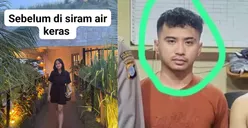Serem! Mahasiswi Yogyakarta Jadi Korban Penyiraman Air Keras Oleh Mantan Pacar, Begini Kronologinya