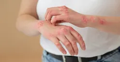 Viral! Virus Mpox Sudah Masuk ke Indonesia, Ini Dia Cara Pemerintah untuk Mencegah Lebih Banyak Lagi Cacar Monyet Masuk!