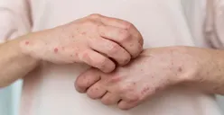 Sekilas Mirip, Ini 6 Perbedaan Antara Mpox, Cacar Air dan Campak