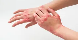 Viral! Virus Mpox atau Cacar Monyet di Indonesia, Ini Dia Cara untuk Lindungi Diri Sendiri dan Orang Lain!