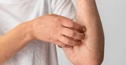 Waspada! Ini Dia Ciri-ciri Orang yang Berisiko Terkena Mpox Beserta Cara Melindungi Diri dari Virus