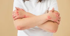 Kasus Monkeypox di Indonesia Makin Meluas, Ketahui Cara Pencegahannya agar Tidak Terpapar Cacar Monyet