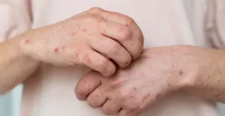 WHO Deklarasikan Wabah Cacar Monyet (Mpox) sebagai Darurat Kesehatan Masyarakat, Sudah Ada Vaksinnya?