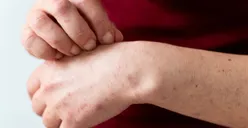 4 Cara Deteksi dan Cegah Mpox (Monkey Pox) atau Cacar Monyet, Alami Gejala Ini Langsung ke Faskes Terdekat