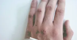 Kamu Terkena Virus Mpox? Jangan Khawatir, Ini Dia Cara Penyembuhan yang Bisa Kamu Ikuti!