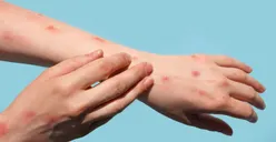 Waspada Mpox! Ini Kelompok Khusus yang Rentan Terinfeksi Virus Cacar Monyet