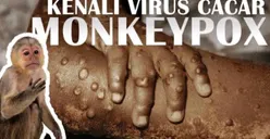 Viral Mpox Mulai Mewabah di Indonesia, Minum Racikan 3 Bahan Herbal Ini Agar Tak Tertular