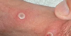 WHO Tetapkan Wabah Mpox Sebagai Darurat Kesehatan Global, Bagaimana di Indonesia?