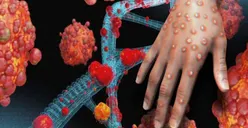 Heboh Virus Mpox Mulai Mewabah di Indonesia, Seperti Ini Gejala dan Cara Penularannya