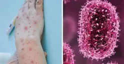 WHO Nyatakan Perang Terhadap Potensi Cacar Monyet, Ini Fakta Virus Mpox yang Perlu Diketahui!