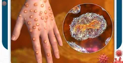 Ini Alasan Kenapa Masyarakat Tidak Perlu Panik Berlebih, Meski oleh WHO Virus Mpox Ditetapkan Sebagai Darurat Kesehatan Global
