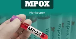 Mulai Terdeteksi di Indonesia, Benarkah Penularan Mpox Tidak Sebahaya Covid-19? Ini Kata Menkes Budi dan Siti Fadila