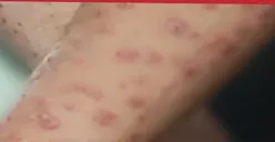 Virus Mpox atau Cacar Monyet Sudah Tersebar di Indonesia, Ternyata Sudah Masuk sejak 2022! di Mana?
