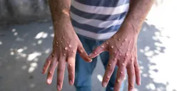 Waspada Penyebaran Virus Mpox, Masyarakat Wajib Tahu Begini Cara Penularan dari Manusia ke Manusia