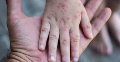WHO Tetapkan Mpox Darurat Kesehatan Global, Kemenkes Masih Kaji Soal Pemberian Vaksin Massal