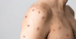 4 Kondisi yang Bisa Membuat Seseorang Terkena Virus Mpox, Cara Penyebaran Ada yang Mirip Covid 19