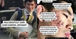 Viral Kisah Mahasiswa UGM Drop Out Gegara Jerawat, Endingnya Bikin Warganet Takjub